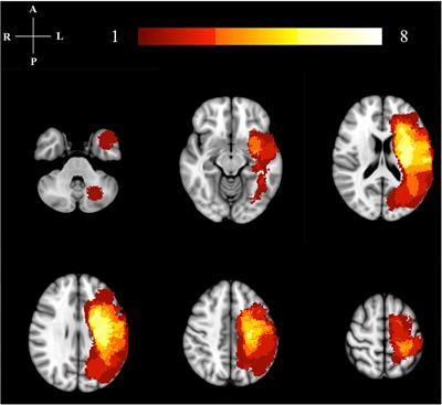 Changes in Cortical Activity in Stroke Survivors Undergoing Botulinum Neurotoxin Therapy for Treatment of Focal Spasticity